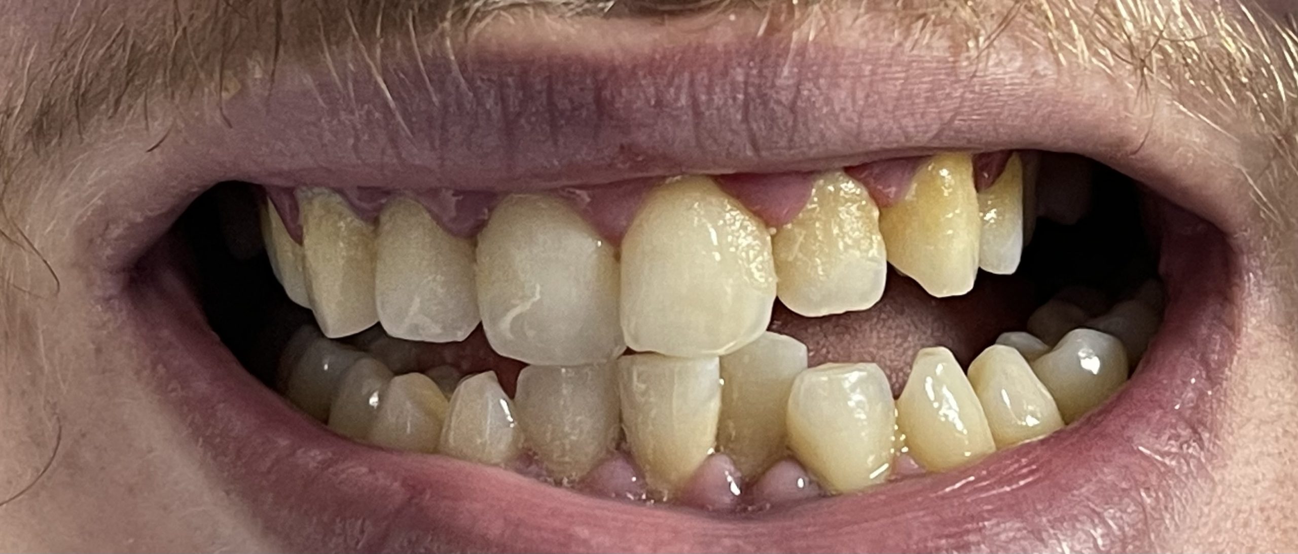 שיניים לפני