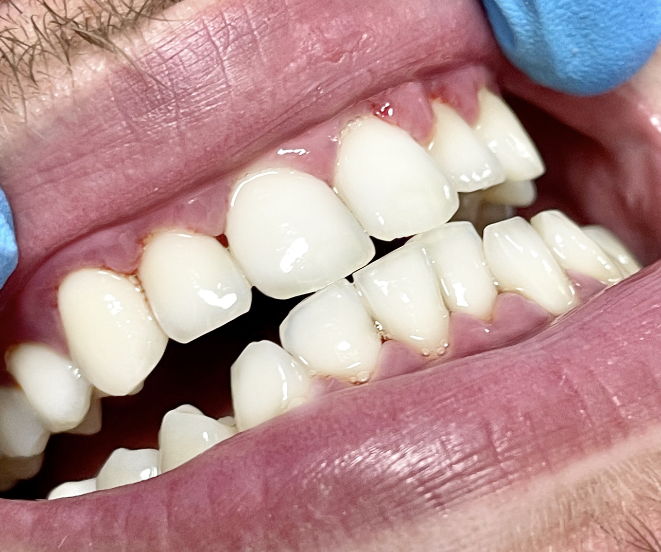 שיניים אחרי