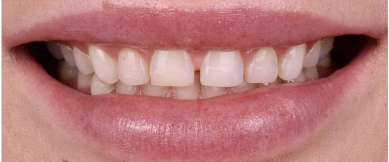 שיניים לפני