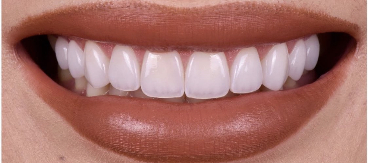 שיניים אחרי