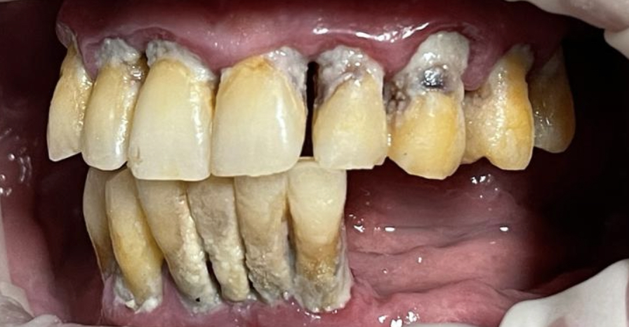 שיניים לפני