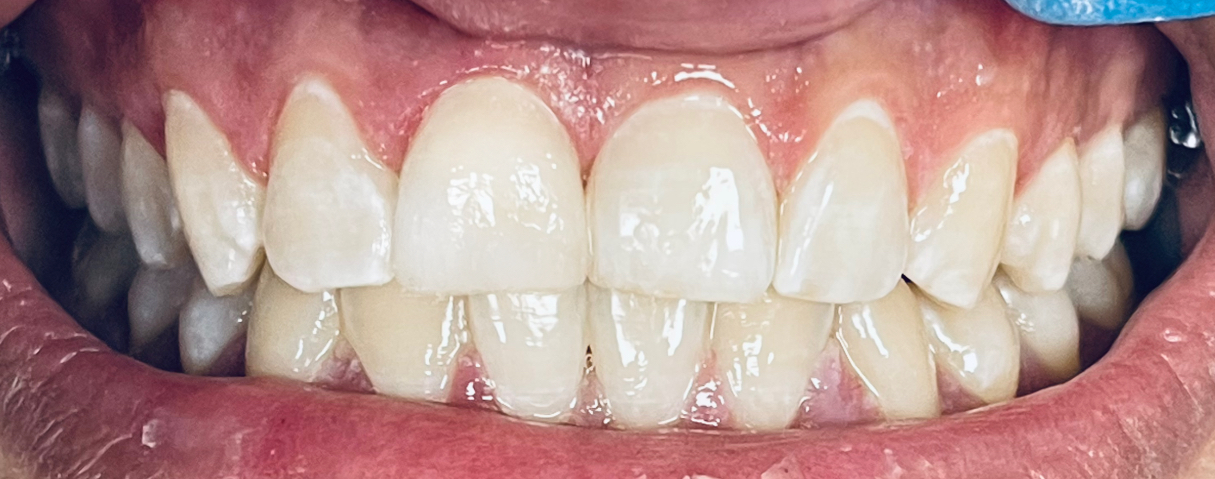 שיניים אחרי