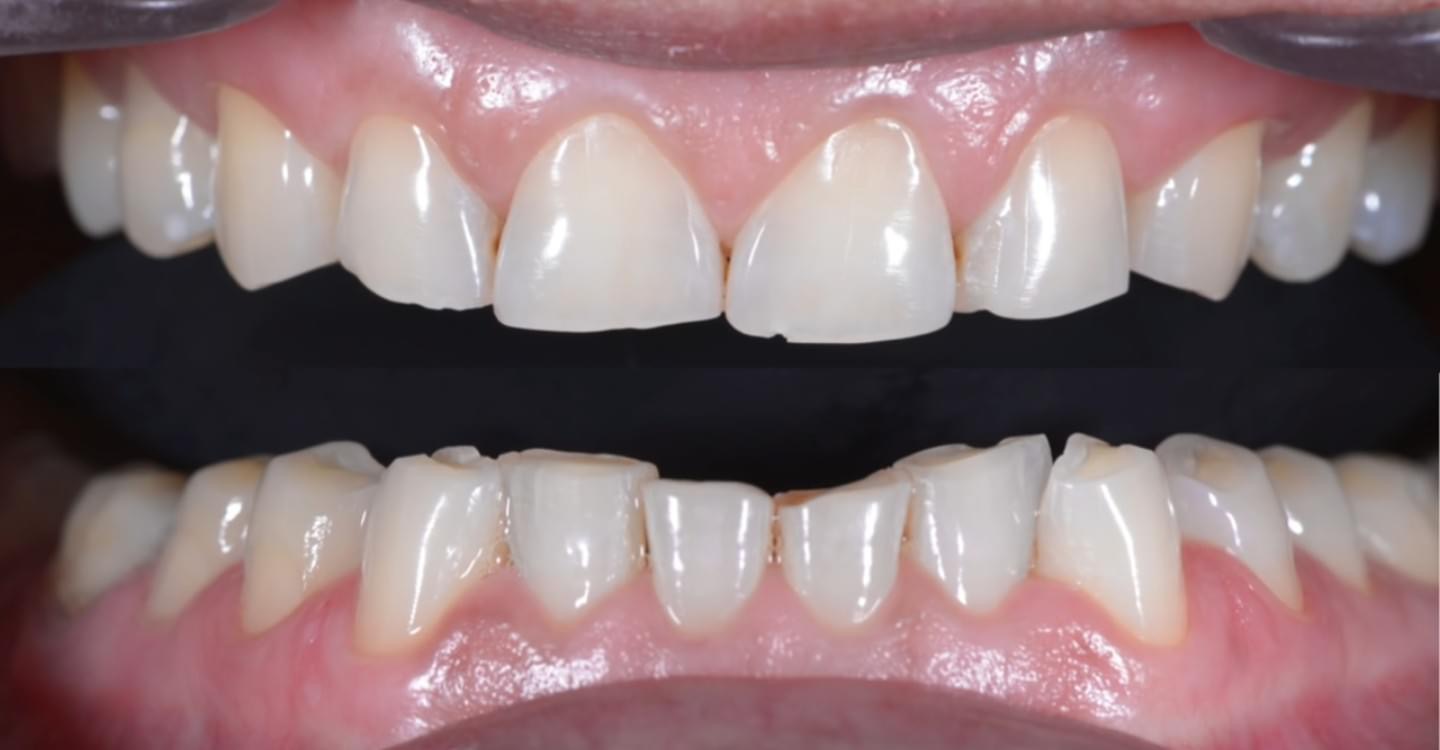 שיניים אחרי