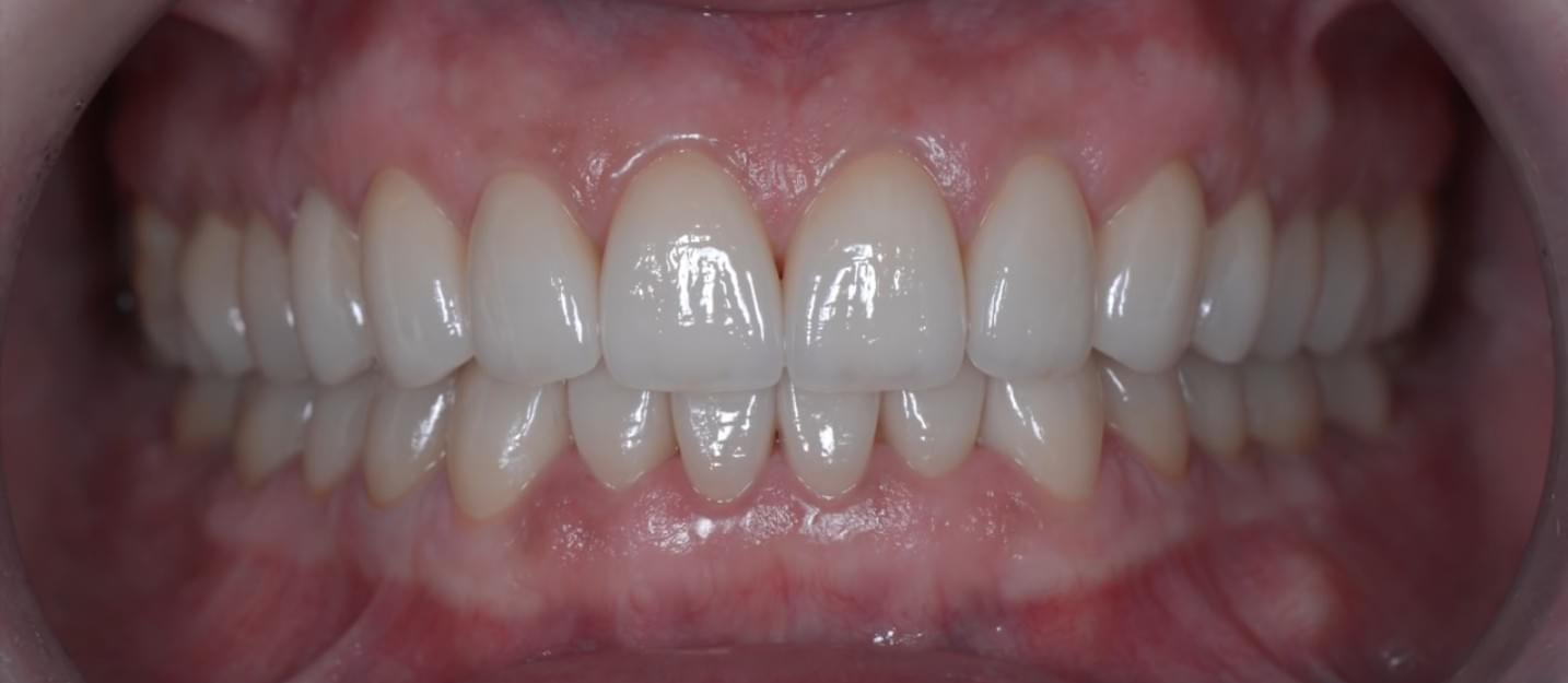 שיניים לפני