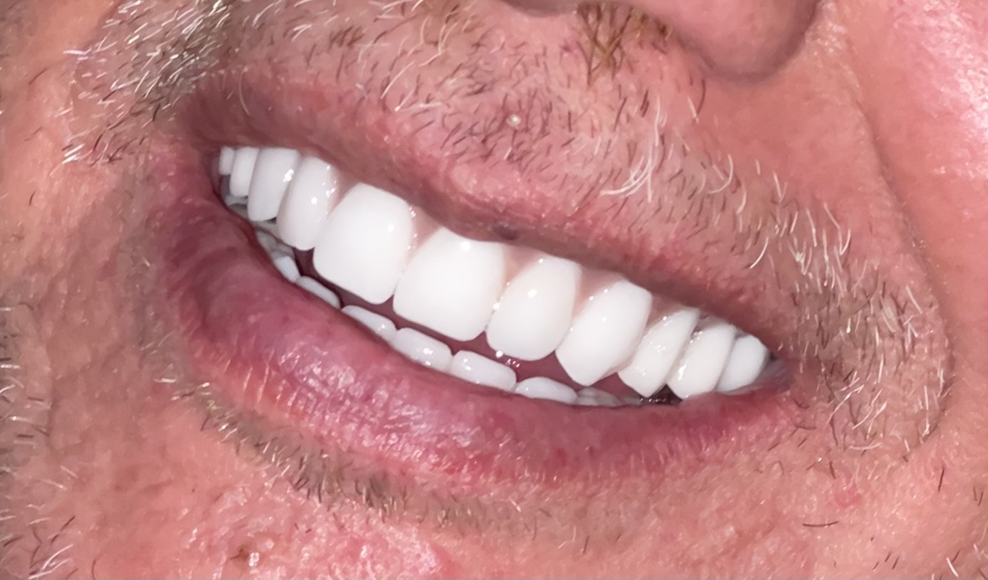 שיניים אחרי